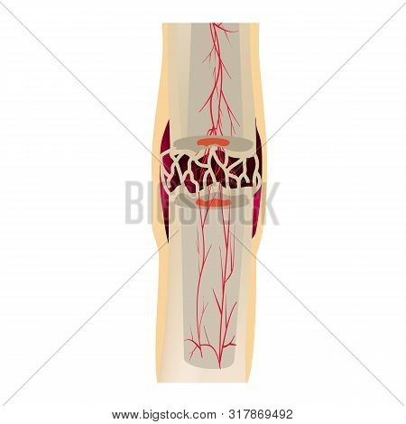 3 Stage Of Healing Bone Fracture. Callus Ossification. The Bone Fracture. Infographics. Illustration
