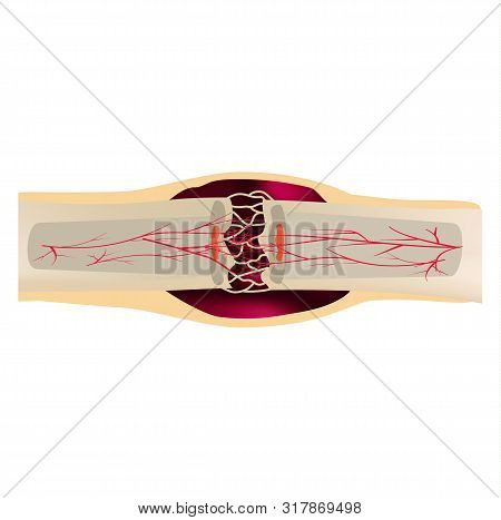 2 Stage Of Healing Bone Fracture. Formation Of Callus. The Bone Fracture. Infographics. Illustration