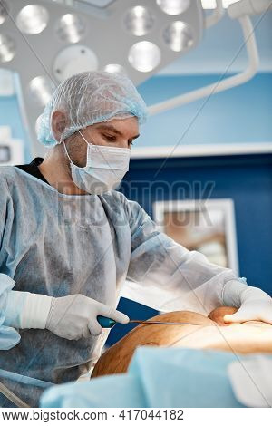 Cosmetic Liposuction Surgery In Actual Operating Room Setting Showing Surgeons Group During Operatio