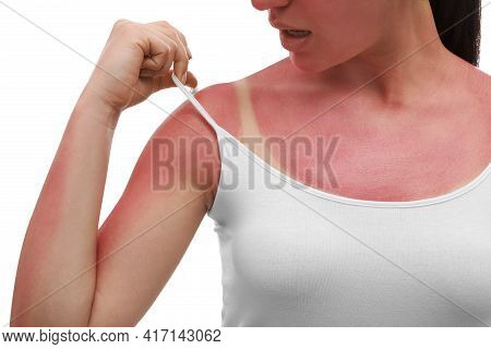 Woman With Sunburned Skin On White Background, Closeup