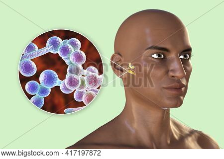 Candida Fungi As A Cause Of Otitis Media. 3d Illustration Showing Purulent Inflammation Of The Middl