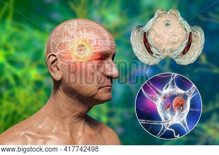An Old Man With Parkinson's Disease And Highlighted Black Substance Of The Midbrain. 3d Illustration