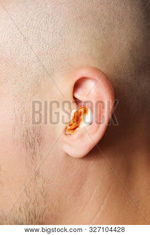 Close Up View Of A Young Man With Bloody Cotton Wool In His Ear. Concept Of Ear Infections, Bleeding