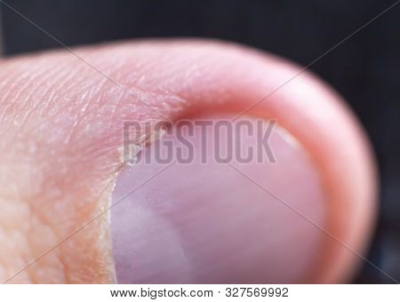 Burr And Cuticle On A Human Nail, Closeup. Background, Macro, Fingernail