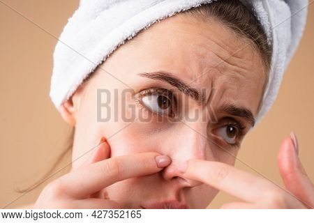 Woman Close Up Face Squeezing Pimples. Acne Blemish Spots Skin On Young Woman. Spot Scar Acne, Freck