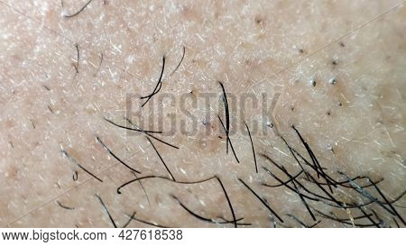 Closeup Of Caucasian Skin With Ingrown Hair And Man Short Beard. Close Up Of Caucasian Skin With Man