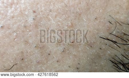 Closeup Of Caucasian Skin With Ingrown Hair And Man Short Beard. Close Up Of Caucasian Skin With Man