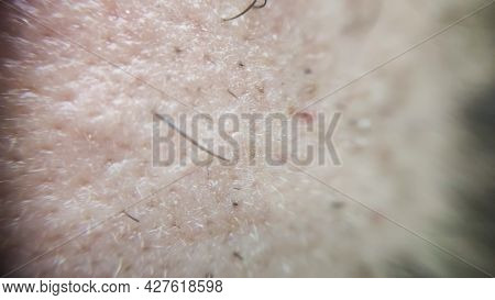 Closeup Of Caucasian Skin With Ingrown Hair And Man Short Beard. Close Up Of Caucasian Skin With Man