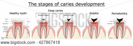 Stages Of Caries Development. Dental Disease: Caries, Pulpitis And Periodontitis, Realistic Vector I