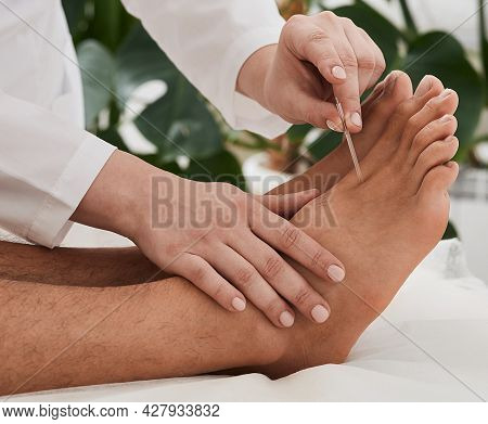 Acupuncture Treatment For Chronic Foot Pain. Chiropractor Doing Acupuncture Therapy For Patient Feet