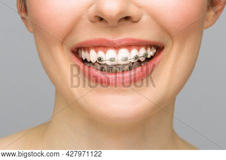 Orthodontic Treatment. Dental Care Concept. Beautiful Woman Healthy Smile Close Up. Closeup Ceramic 