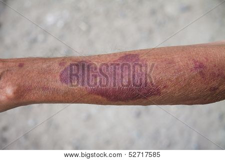 Blood outpouring under skin