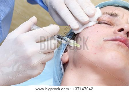 Bio-revitalization With Hyaluronic Acid Treatment Of Mimic Wrinkles.
