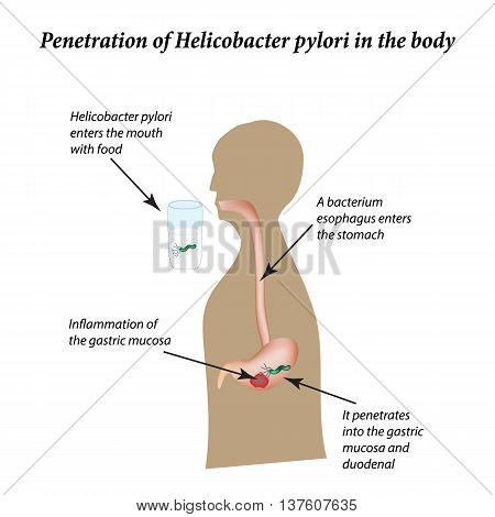 Infection with Helicobacter pylori. Infographics. Vector illustration on isolated background.