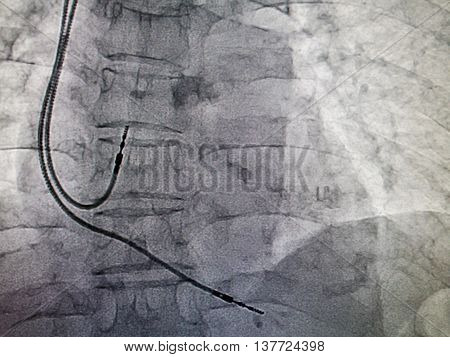 DDDR pacemaker cable in x-ray image in cardiac catheterization laboratory