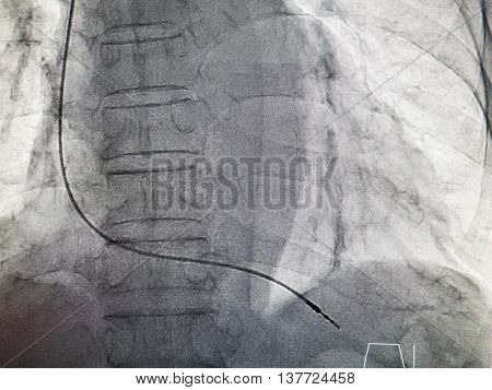 VVIR pacemaker cable in x-ray image in cardiac catheterization laboratory