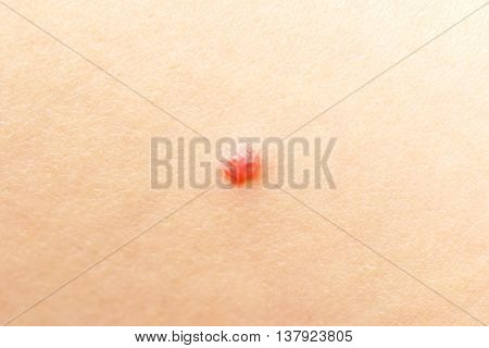 Cherry Angioma or Campbell de Morgan spots