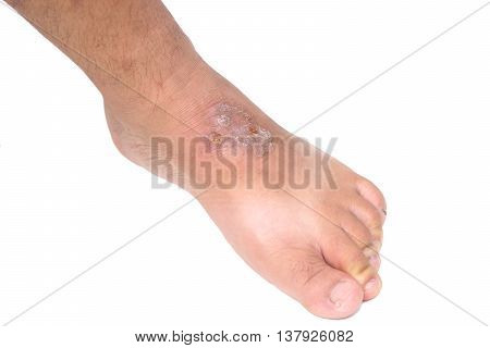 Infectious wound on foot isolated on white