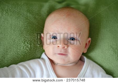 Allergies, Atopic Dermatitis On The Face Of A Baby