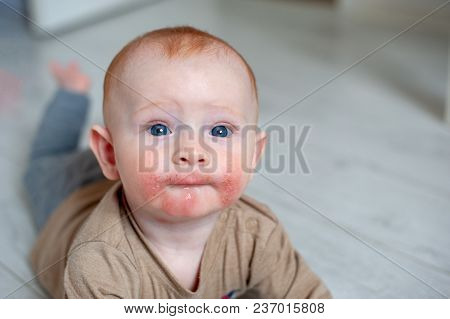 Traces Of Diathesis, Allergies On Baby Cheeks