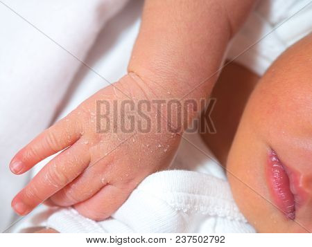 Closeup Hand Of A Newborn With A Skin Peeling On White Cloth. Skin Allergies In Newborn Called Verni