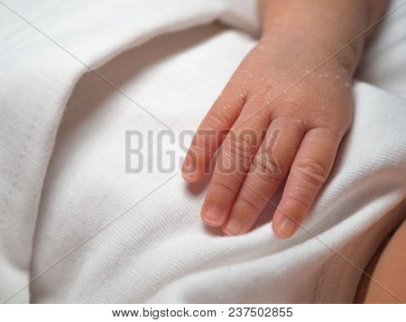 Closeup Hand Of A Newborn With A Skin Peeling On White Cloth. Skin Allergies In Newborn Called Verni