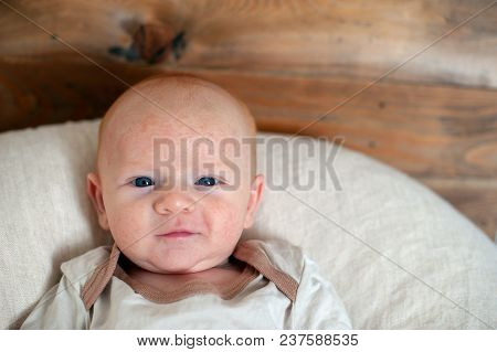 Allergies, Atopic Dermatitis On The Face Of A Baby