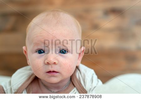 Allergies, Atopic Dermatitis On The Face Of A Baby