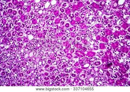Histopathology Of Acute Nephritis, Light Micrograph, Photo Under Microscope