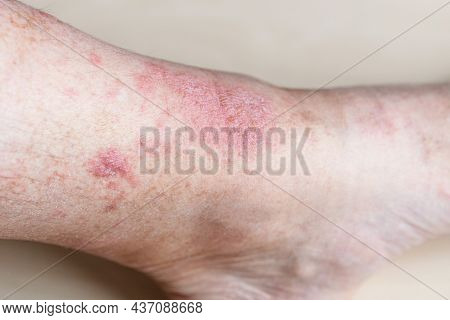 Sample Of Allergic Contact Dermatitis - Eczema On Male Shin Close Up