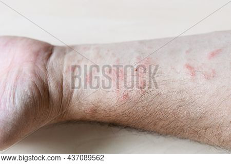 Sample Of Allergic Contact Dermatitis - Rash On Inner Side Of Forearm Close Up