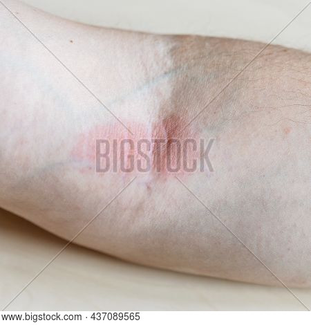 Sample Of Allergic Contact Dermatitis - Redness On Iinner Bend Of The Elbow Close Up