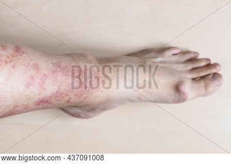 Sample Of Allergic Contact Dermatitis - Male Shin With Redness And Itchy Rash On Skin