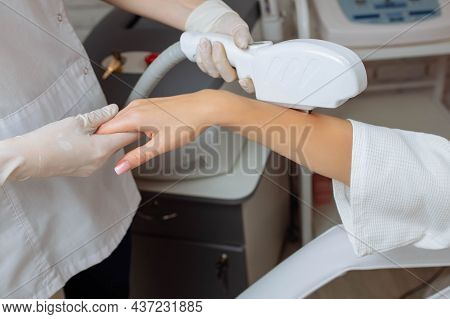 Laser Hair Removal Of Hand Hair. Doctor Cosmetologist Removes The Hair On His Hands With The Help Of