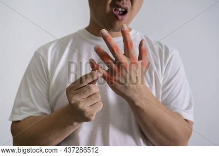 Man Hand Suffering From Joint Pain With Gout In Finger. Cause Of Pain Include Rheumatoid Arthritis, 