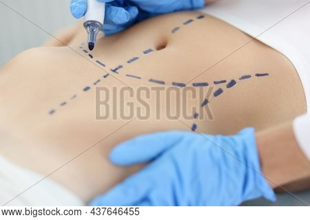 Doctor Plastic Surgeon Drawing Preoperative Markings On Skin Of Patient Abdomen Closeup