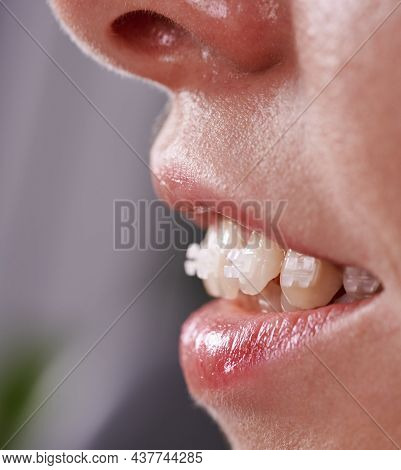 Close Up Of Young Smiling Woman With Opened Mouth Demonstrating White Teeth With Orthodontic Bracket