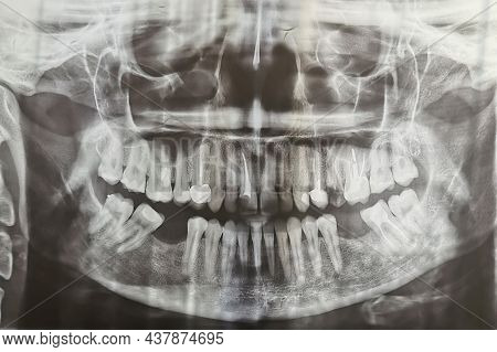 Dental Radiography. Digital X-ray Teeth Scan Of Adult Female. Human Teeth X-ray Front View