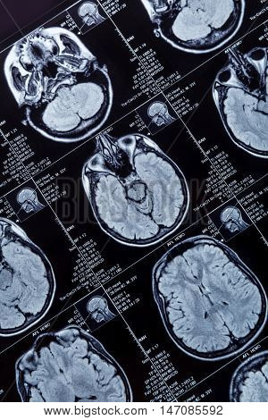 Magnetic resonance imaging