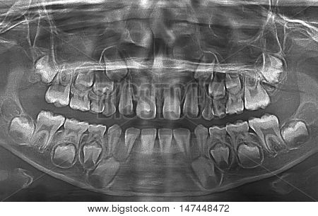 Close up of X ray image of achild teeth