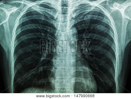 X-Ray Image Of Human Chest for a medical diagnosis