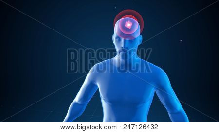 Model Of A Man With Impulses Of A Headache, Medical Concept