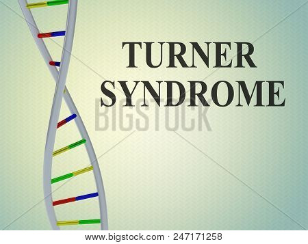 3d Illustration Of Turner Syndrome Script With Double Helix, Isolated On Colored Background.