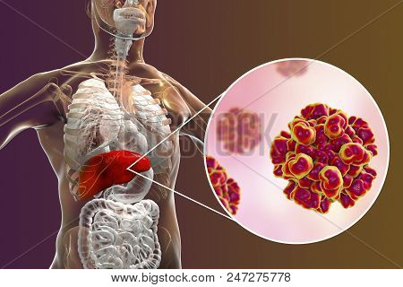 Hepatitis E Viral Infection, 3d Illustration. Non-enveloped Rna Viruses With Fecal-oral Transmission