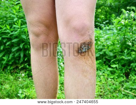 Legs Of A Teenager With A Purulent Abrasion On His Knee