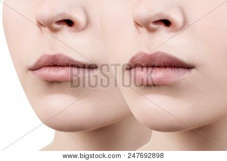 Beautiful Lips Of Young Woman. Before And After Lips Filler Injections. Fillers Concept.