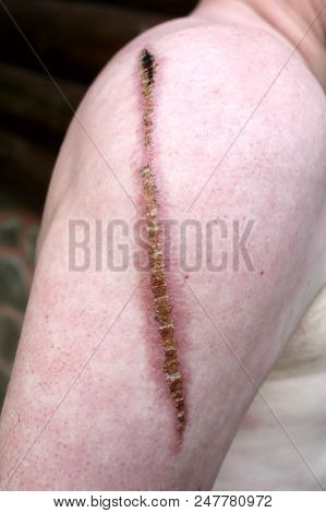 Shoulder With Scar From Burn