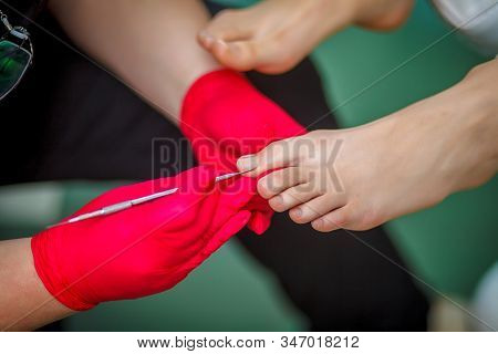 Podiatrist Treating Toenail Fungus. Podology Treatment. Close-up.