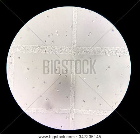 Moderate Dysmorphic Red Blood Cells In Urine Sediment.