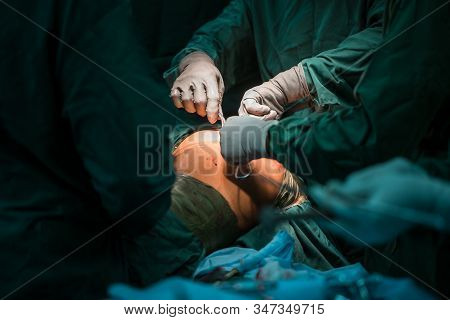 Surgical Team. Sterile Operating Room. Total Hip Arthroplasty With Cement Fixation Of Components. Pr